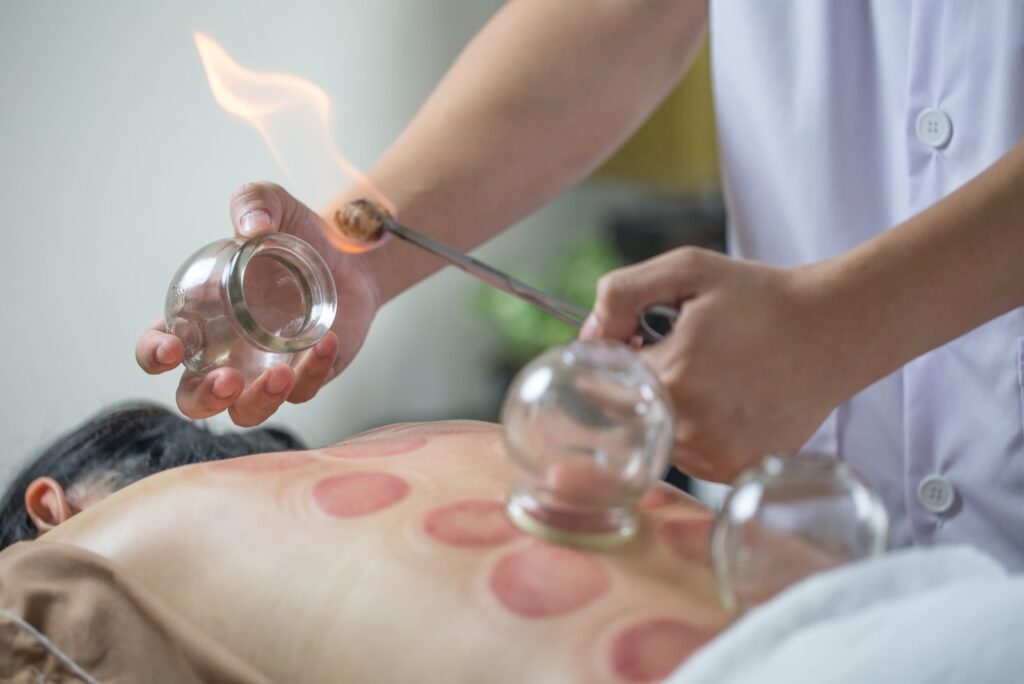 cupping