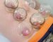 Cupping Therapy in clinic